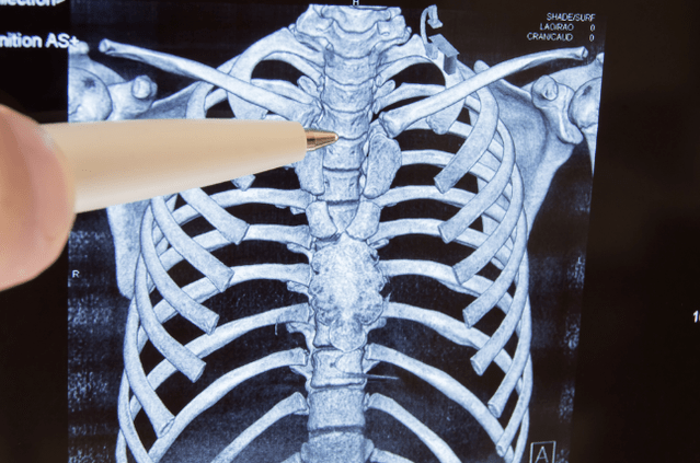 OsteOnochonRos